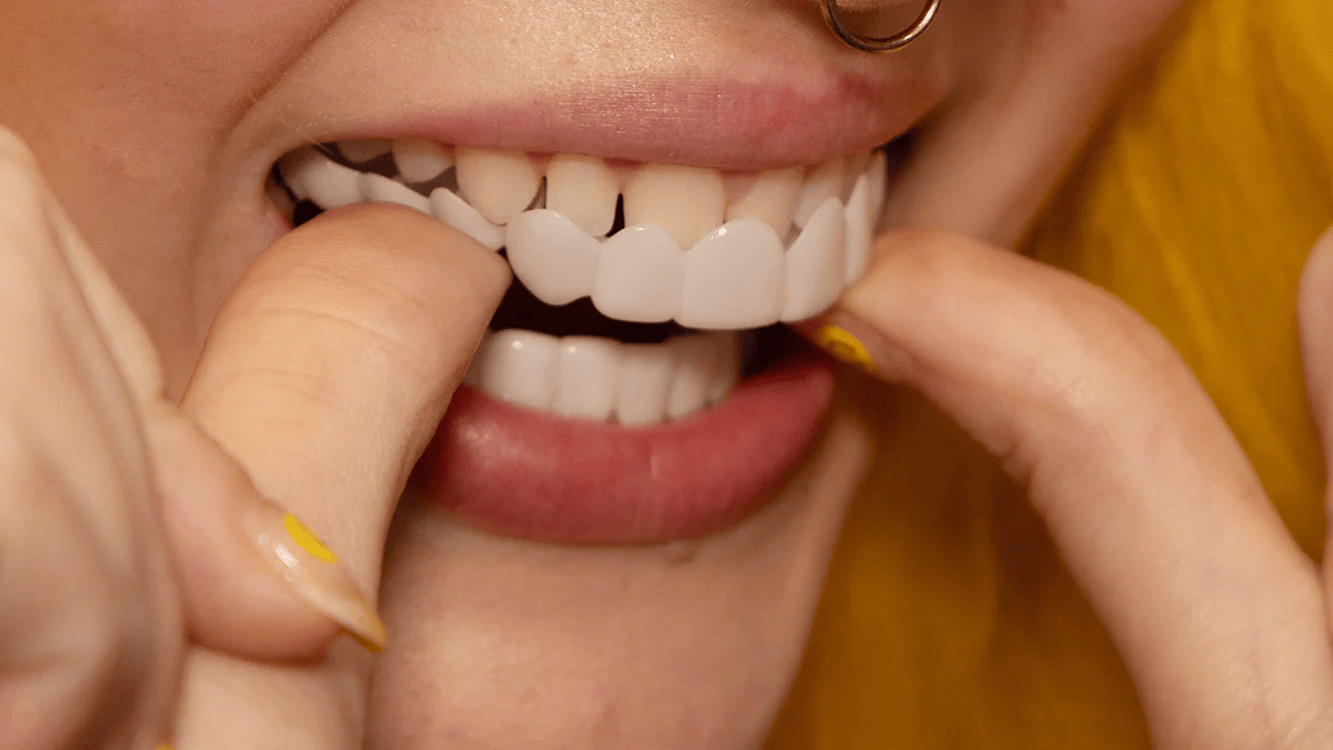 Snap on Smile Veneers